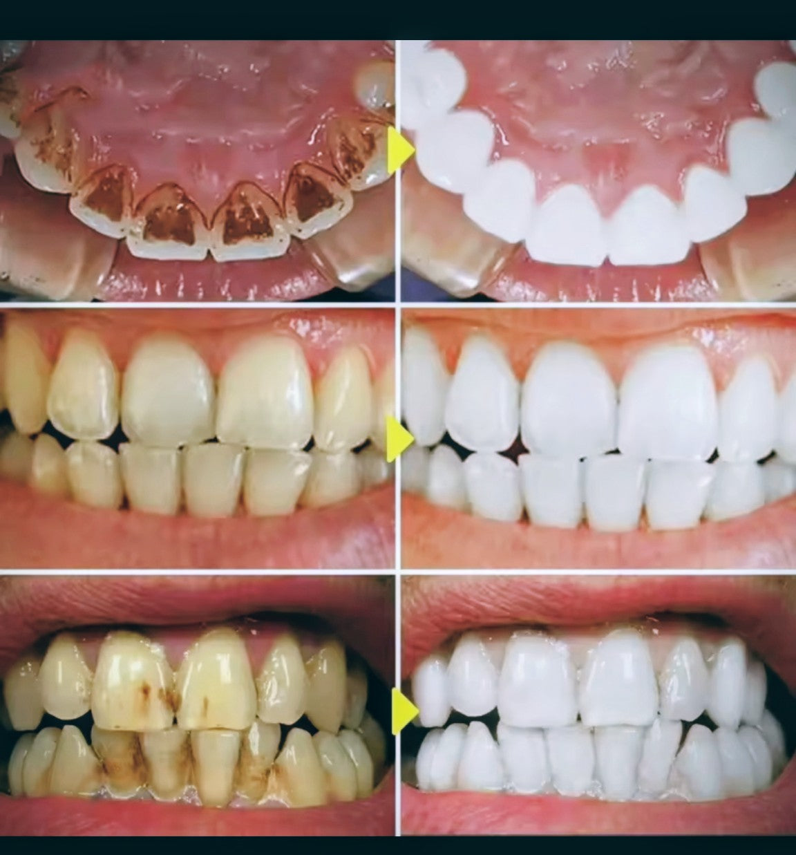 Dentifrice Ultra-Blanchissente whitesmile